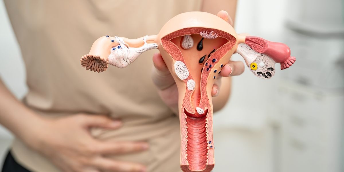 uterine fibroids uterine fibroids