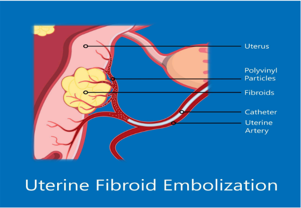 Uterine Fibroid Embolization
