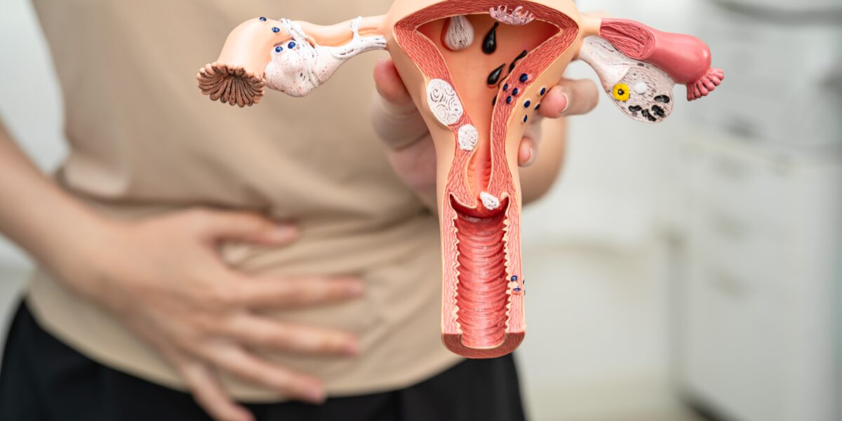 Uterine Fibroid Embolization
